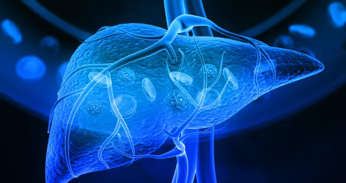 Mini-examen clínico: Evalúe sus conocimientos sobre cáncer de hígado