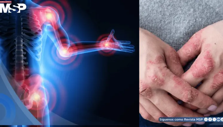 Artritis psoriásica después de los 60 años presenta más comorbilidades y menor acceso a biológicos Artritis psoriásica después de los 60 años presenta más comorbilidades y menor acceso a biológicos