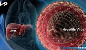 &iquest;Fatiga constante, dolor abdominal o piel amarillenta? Podr&iacute;an ser s&iacute;ntomas de hepatitis autoinmune