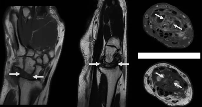 Paciente con fractura vertebral previa desarrolla edema y dolor por Kienböck estadio IV en mano derecha  Paciente con fractura vertebral previa desarrolla edema y dolor por Kienböck estadio IV en mano derecha