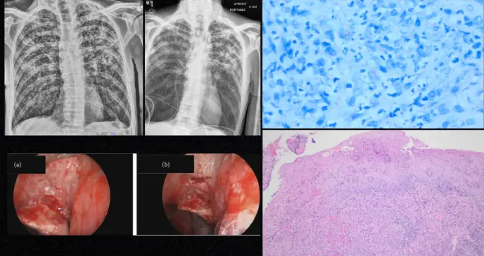 Presentación inusual de tuberculosis extrapulmonar como masa laríngea en un paciente atípico