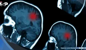 Traumatismos craneoencef&aacute;licos moderados y graves aumentan el riesgo de tumores cerebrales malignos