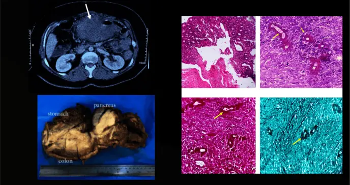 Basidiobolomicosis gastrointestinal es confundida con colitis ulcerosa en paciente con masa abdominal