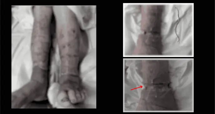 Banda elástica olvidada como causa de úlcera con necrosis en extremidad inferior de paciente con diabetes