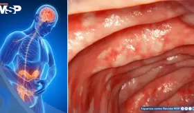 Por qué ciertos mecanismos del tabaco benefician a la colitis ulcerosa y cómo replicarlos sin fumar