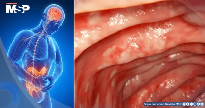 Por qué ciertos mecanismos del tabaco benefician a la colitis ulcerosa y cómo replicarlos sin fumar