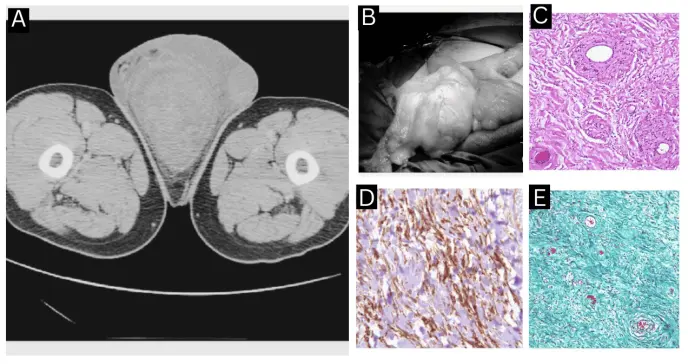 Angiomixoma agresivo escrotal confundido con hidrocele en un paciente masculino de 64 años