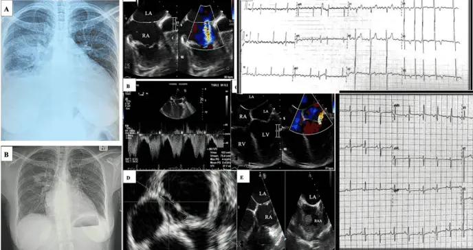 Descubren incidentalmente una rara malformación cardíaca en mujer con VIH y severa disfunción ventricular