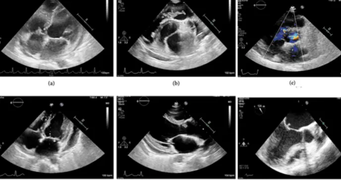 Bacteria oral causa endocarditis infecciosa en las cuatro válvulas del corazón en mujer de 42 años Bacteria oral causa endocarditis infecciosa en las cuatro válvulas del corazón en mujer de 42 años