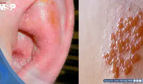 Joven con VIH sin tratar desarrolla p&eacute;rdida auditiva y par&aacute;lisis facial por virus de la varicela z&oacute;ster