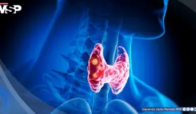 &iquest;Hipertiroidismo o hipotiroidismo? C&oacute;mo reconocer sus s&iacute;ntomas y diferenciarlos