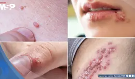 Verrugas por VPH y herpes genital: &iquest;Por qu&eacute; no son lo mismo y c&oacute;mo diferenciarlas?