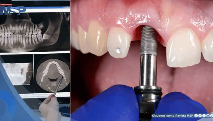 Implantes orales metálicos estarían aumentando el riesgo de enfermedades, según estudios Implantes orales metálicos estarían aumentando el riesgo de enfermedades, según estudios