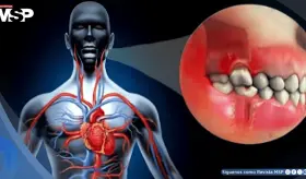 Bacterias bucales podr&iacute;an migrar a las arterias, causar inflamaci&oacute;n y aumentar el riesgo de infarto