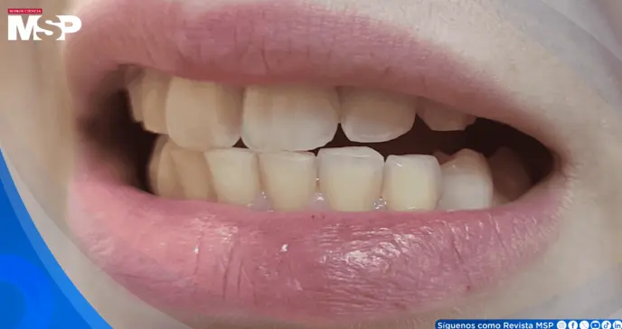 Bruxismo por trastorno de ansiedad ocasiona cefaleas tensionales y dolor cervical en joven de 19 años