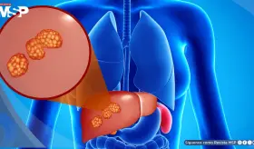 Dolor abdominal, hinchazón e ictericia: Así se manifiestan los quistes hepáticos complicados