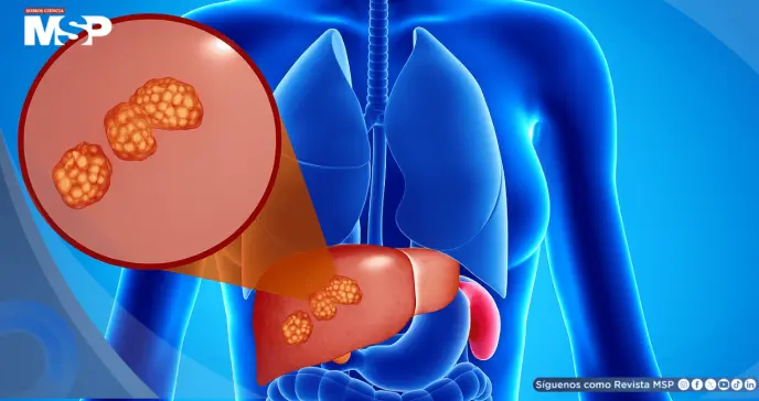 Dolor abdominal, hinchazón e ictericia: Así se manifiestan los quistes hepáticos complicados Dolor abdominal, hinchazón e ictericia: Así se manifiestan los quistes hepáticos complicados