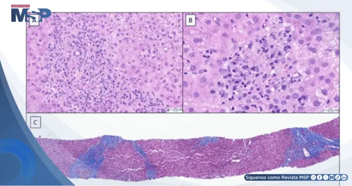 Hepatitis autoinmune inducida por anastrozol con orina oscura e hiporexia en paciente con cáncer de mama