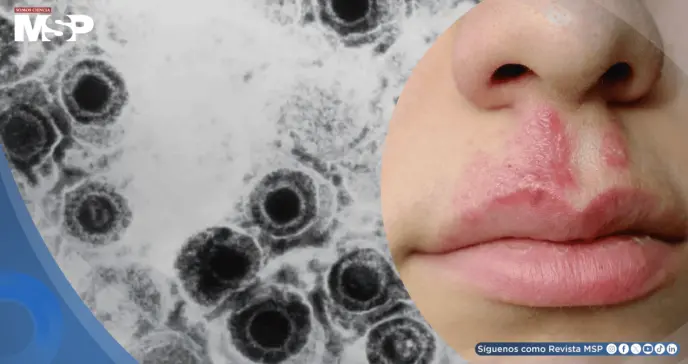 Desarrollan un nuevo antiviral efectivo contra cepas resistentes del virus del herpes