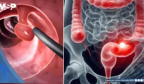 ¿Sangrado rectal? Podría ser señal temprana de cáncer colorrectal en adultos jóvenes