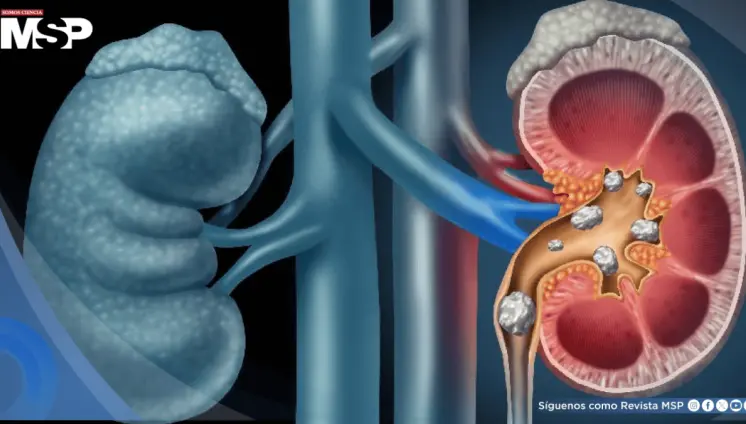 Trabajar de noche podría aumentar el riesgo de cálculos renales, advierte estudio Trabajar de noche podría aumentar el riesgo de cálculos renales, advierte estudio