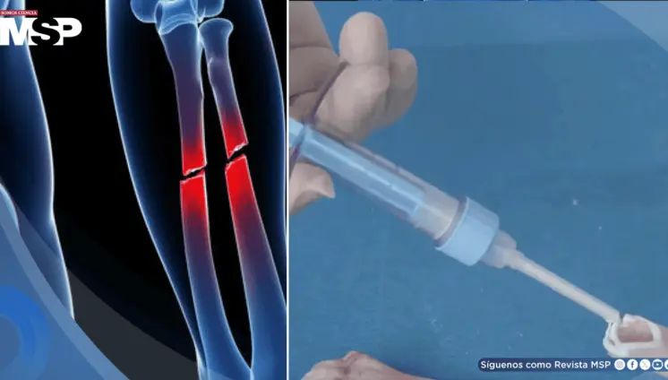 Desarrollan pegamento óseo que repara fracturas en tres minutos y podría reemplazar tornillos y placas