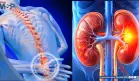 ¿Dolor de espalda o problema renal? Reconoce las señales que alertan sobre una afección en el riñón 