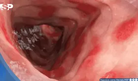 FDA aprueba primer tratamiento para colitis ulcerosa en ni&ntilde;os que logra remisi&oacute;n del 32% en estudios
