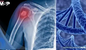 Identifican un nuevo gen que eleva el riesgo de osteosarcoma, el cáncer óseo más común en niños