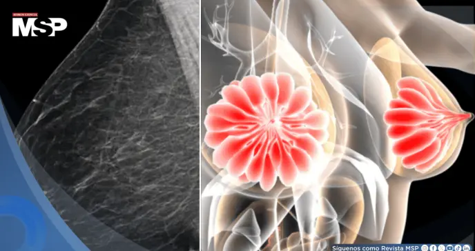 Descubren que la densidad mamaria podría dificultar la detección del cáncer de mama Descubren que la densidad mamaria podría dificultar la detección del cáncer de mama