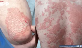 Estudio vincularía a la psoriasis con un riesgo elevado de padecer múltiples tipos de cáncer