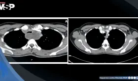 Quiste mediastínico broncogénico y dolor torácico en embarazada muestra regresión espontánea tras parto