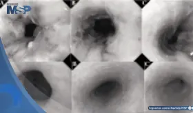 Paciente desarrolla esofagitis por reflujo grave tras 6 meses de tratamiento con semaglutida por vómitos