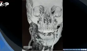 Rara malformación arteriovenosa mandibular causa hemorragia masiva en una mujer embarazada a término