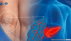 ¿Coágulo doloroso en la pierna? Podría ser la primera señal de cáncer de páncreas