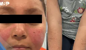 Erupción facial fotosensible lleva al diagnóstico de lupus eritematoso sistémico en paciente pediátrica