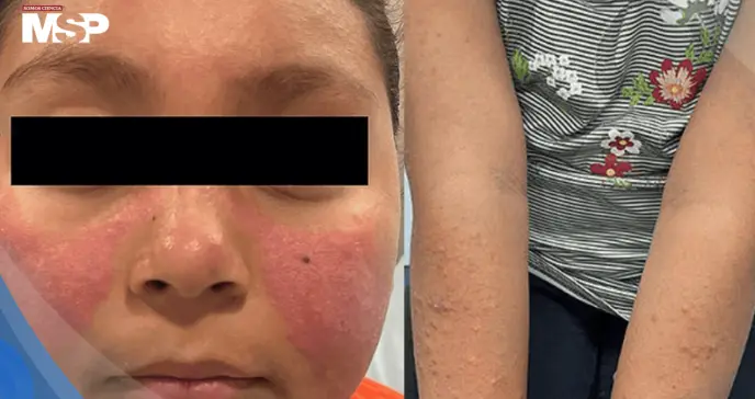 Erupción facial fotosensible lleva al diagnóstico de lupus eritematoso sistémico en paciente pediátrica Erupción facial fotosensible lleva al diagnóstico de lupus eritematoso sistémico en paciente pediátrica