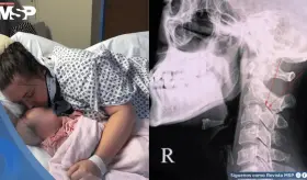 Mujer presenta fractura cervical tras bostezar: Desplazamiento de vértebras  C6 y C7 provocó parálisis