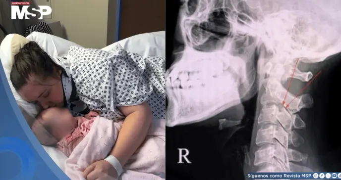 Mujer presenta fractura cervical tras bostezar: Desplazamiento de vértebras  C6 y C7 provocó parálisis Mujer presenta fractura cervical tras bostezar: Desplazamiento de vértebras  C6 y C7 provocó parálisis