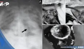 Muerte súbita intraoperatoria por embolia gaseosa secundaria al uso de peróxido de hidrógeno