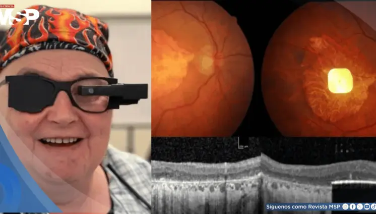 Desarrollan implante fotovoltaico que devuelve la capacidad de leer a personas con degeneración macular Desarrollan implante fotovoltaico que devuelve la capacidad de leer a personas con degeneración macular