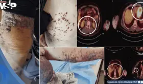 Detectan 3 tipos distintos de cáncer cutáneo en paciente de 83 años con problemas cardiacos 