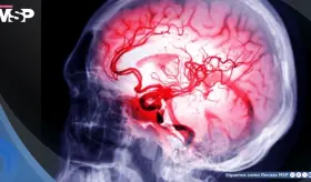 ¿Qué es un aneurisma cerebral? El más reciente diagnóstico de Kim Kardashian relacionado con el estrés