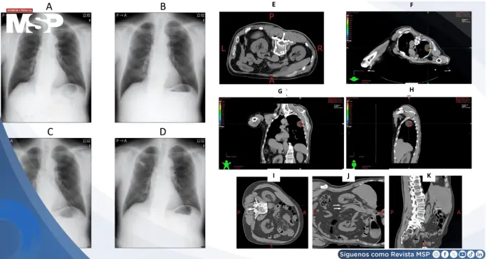 Náuseas y sudoración súbita durante radioterapia resultó en compresión idiopática de vena cava inferior Náuseas y sudoración súbita durante radioterapia resultó en compresión idiopática de vena cava inferior