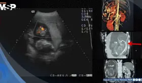 Diagnostican embarazo intrahepático de 23 semanas en mujer de 27 años: el feto crecía dentro del hígado