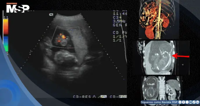 Diagnostican embarazo intrahepático de 23 semanas en mujer de 27 años: el feto crecía dentro del hígado Diagnostican embarazo intrahepático de 23 semanas en mujer de 27 años: el feto crecía dentro del hígado