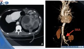 Aneurisma roto simuló infección urinaria: Dolor lumbar e hidronefrosis confundieron el diagnóstico