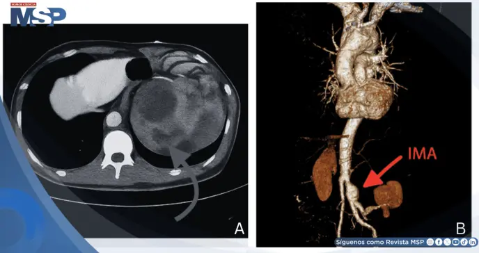 Aneurisma roto simuló infección urinaria: Dolor lumbar e hidronefrosis confundieron el diagnóstico Aneurisma roto simuló infección urinaria: Dolor lumbar e hidronefrosis confundieron el diagnóstico