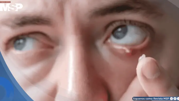 Orzuelos: por qué aparecen, cómo tratarlos y qué hacer para prevenirlos
