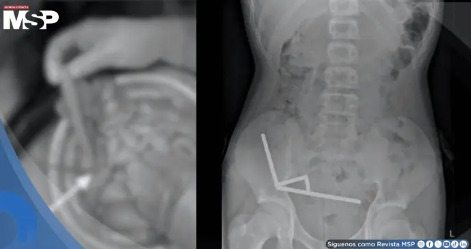 Adolescente ingirió más de 100 imanes de neodimio: La cadena afectó irreparablemente el intestino Adolescente ingirió más de 100 imanes de neodimio: La cadena afectó irreparablemente el intestino
